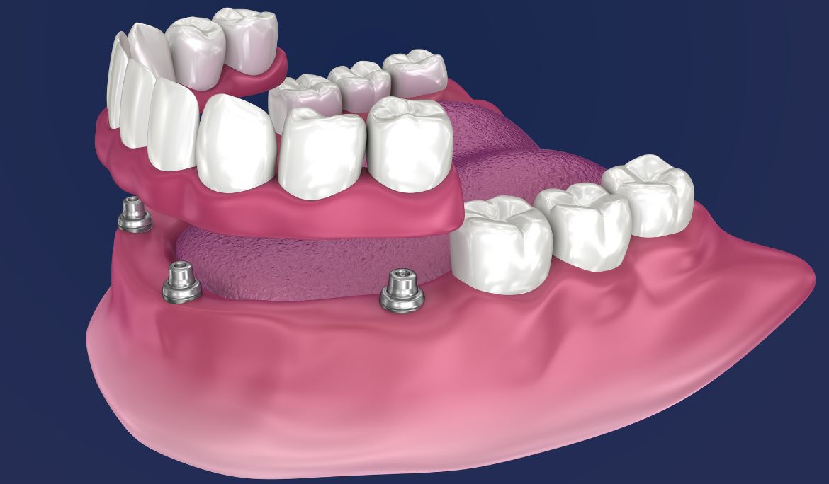 what to expect during the all on 4 dental implants procedure