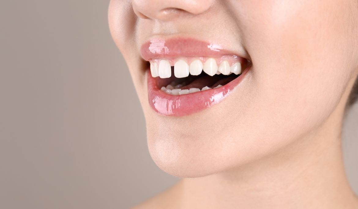 can cosmetic dentistry fix gaps without braces