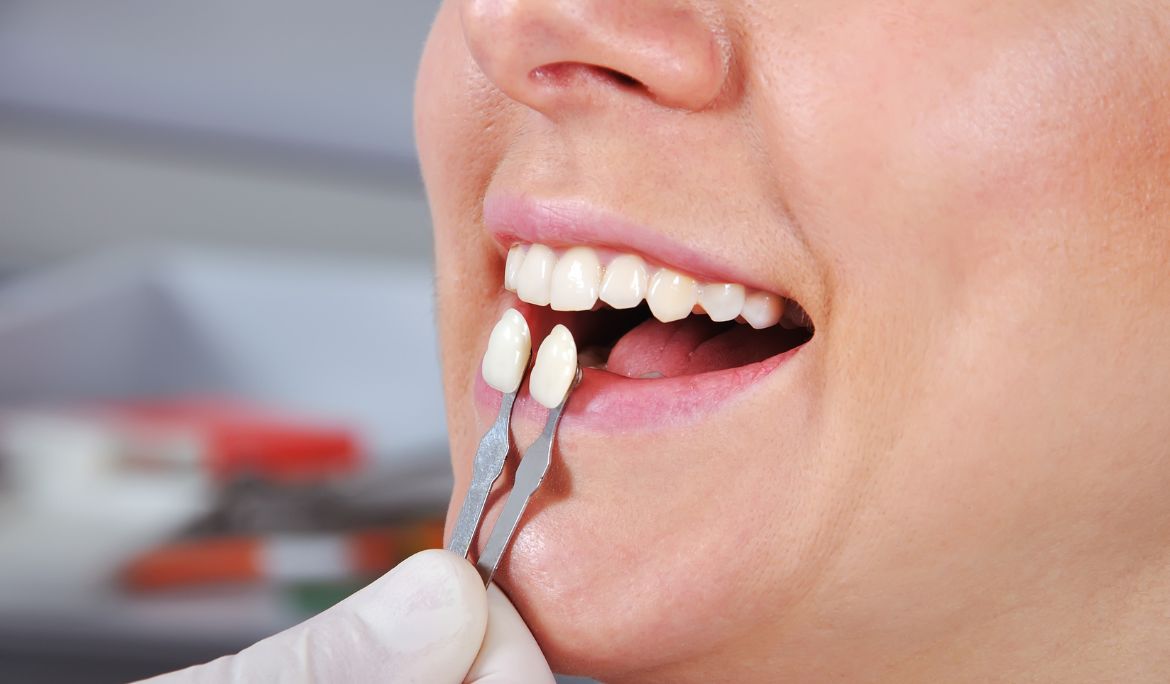 are dental crowns the best for restoring teeth